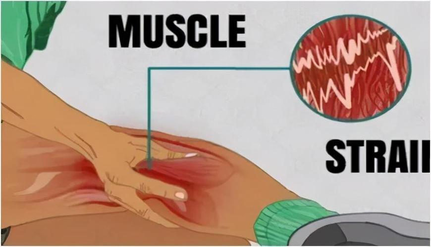 扭伤,拉伤,肌肉疲劳丨常见的运动伤病要怎么办处理？(图1)